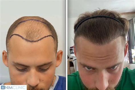 The Price of Confidence: Bkue Magic's Affordable Hair Transplant in Turkey